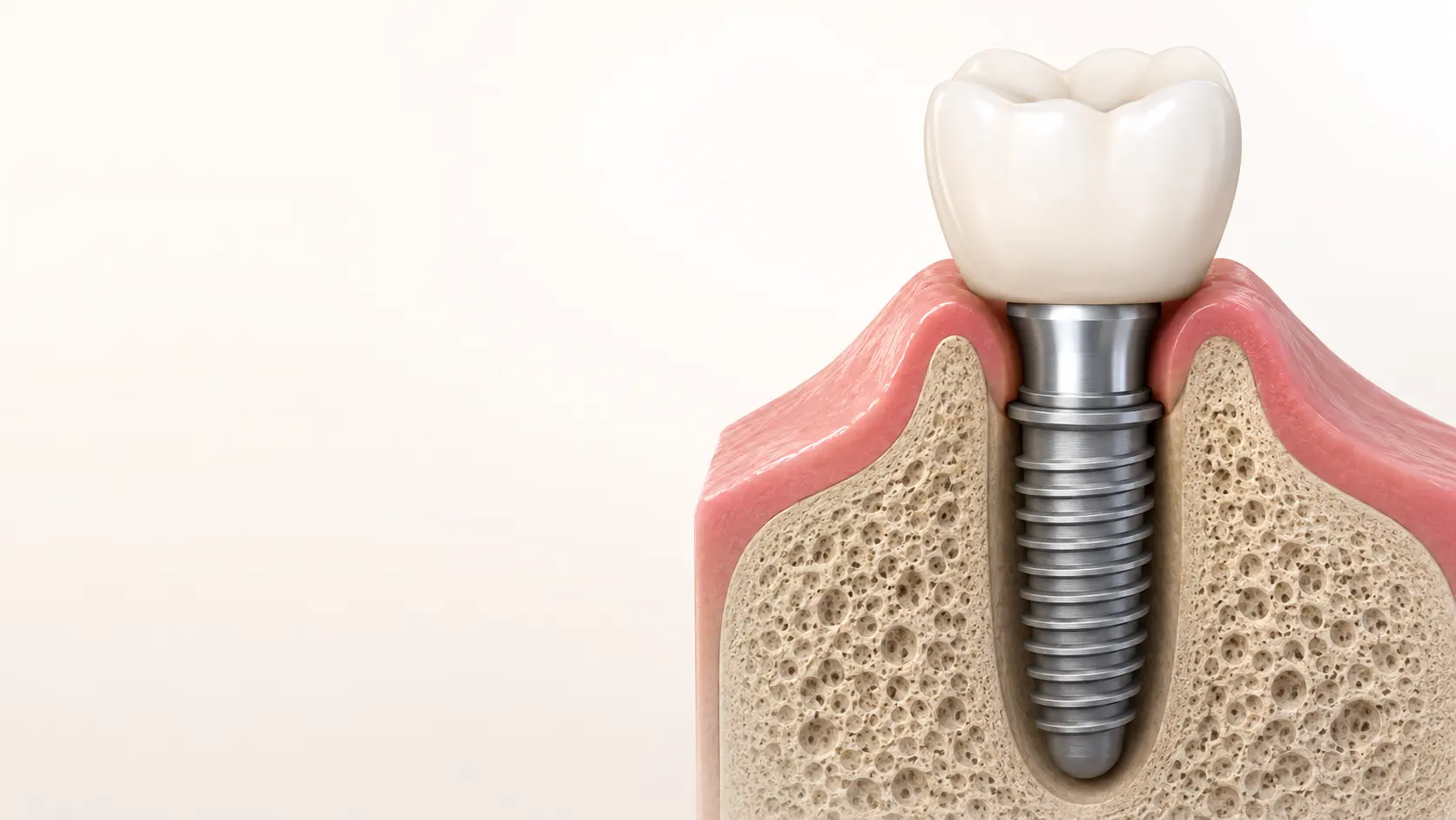 Coupe 3D montrant un implant dentaire, son pilier et sa couronne.