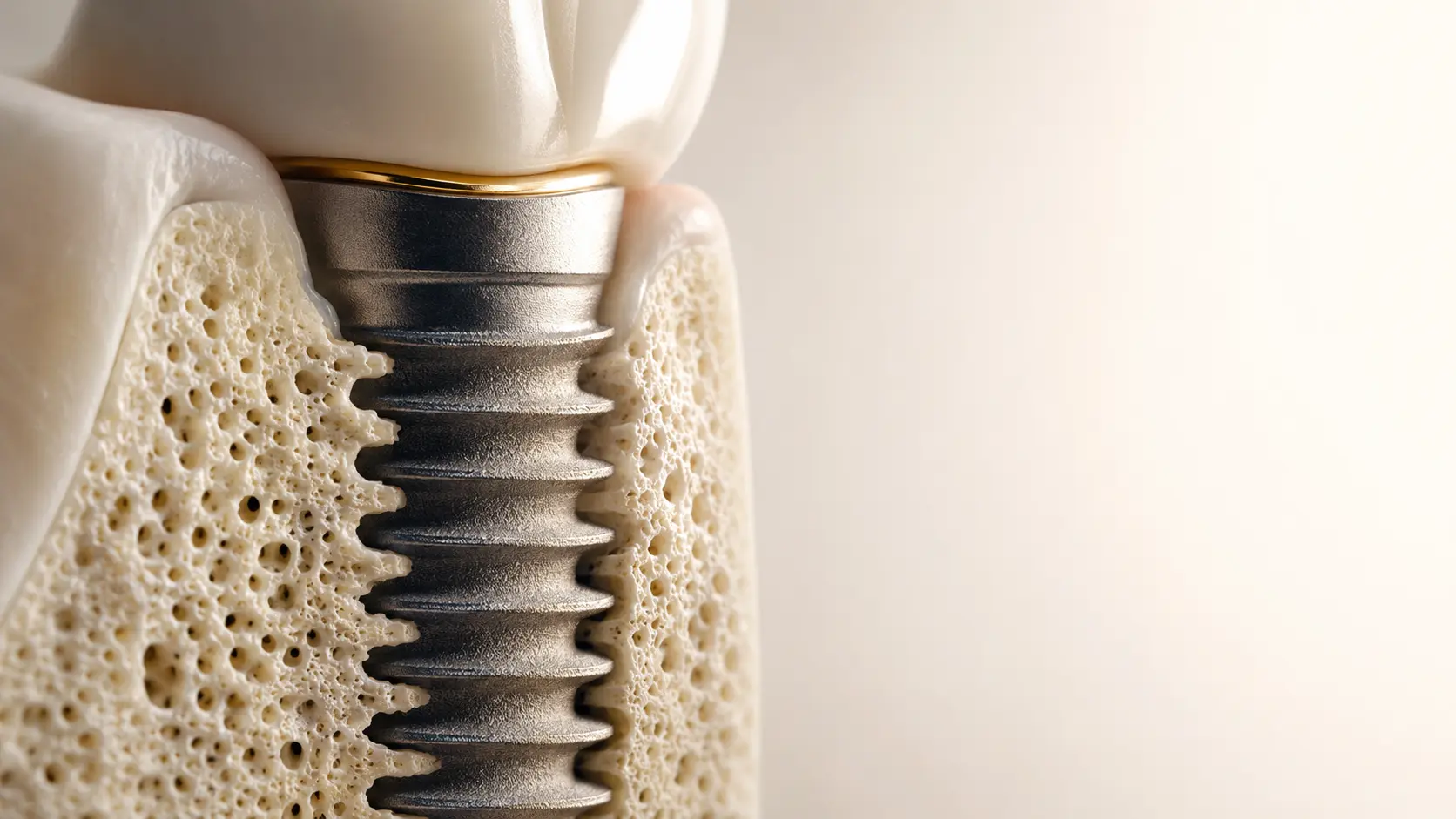 Gros plan illustrant le contact entre l’os et la surface d’un implant dentaire.