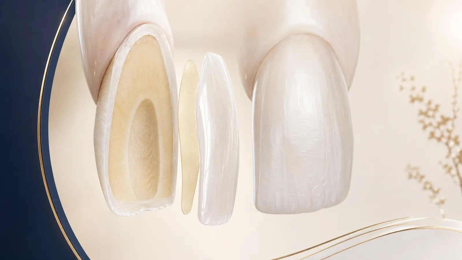 Coupe pédagogique d’une dent montrant une facette céramique et sa couche de collage