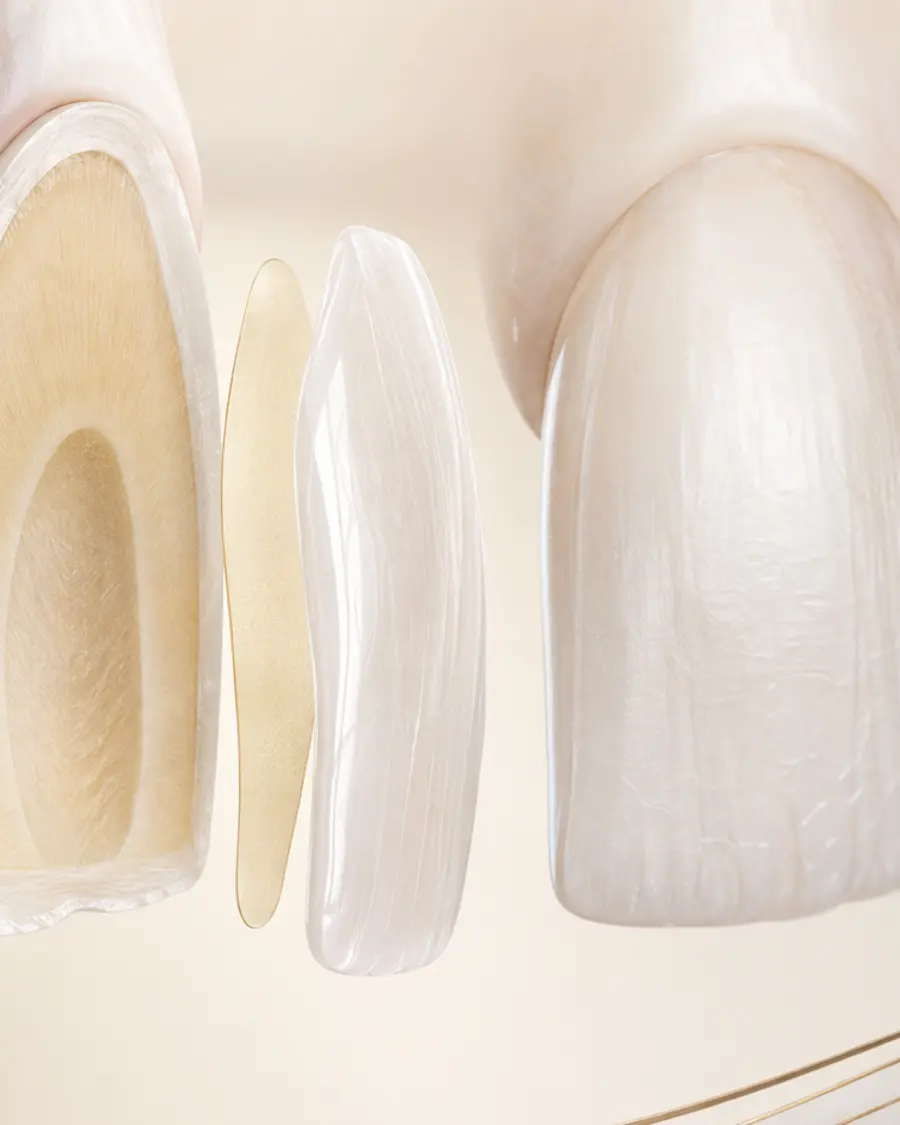 Coupe pédagogique d’une dent montrant une facette céramique et sa couche de collage