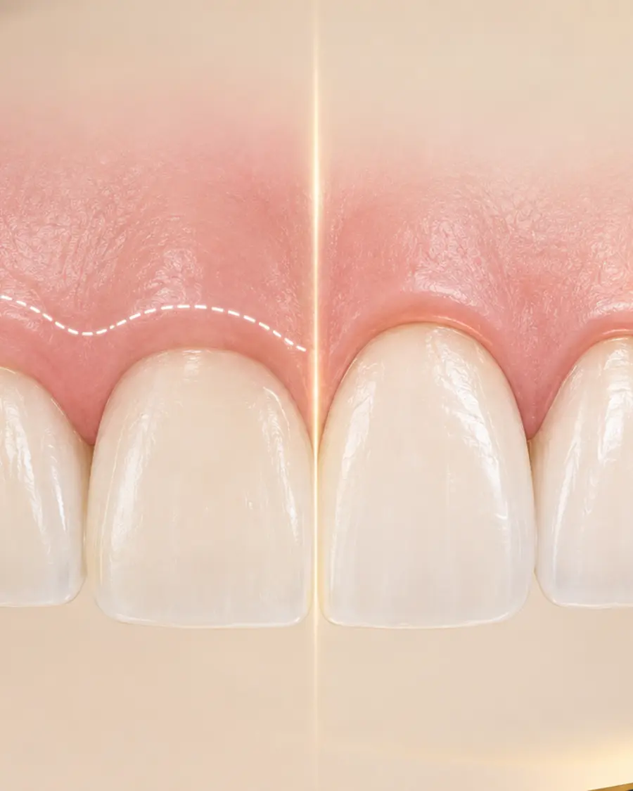Educational comparison of a gum line before and after reshaping
