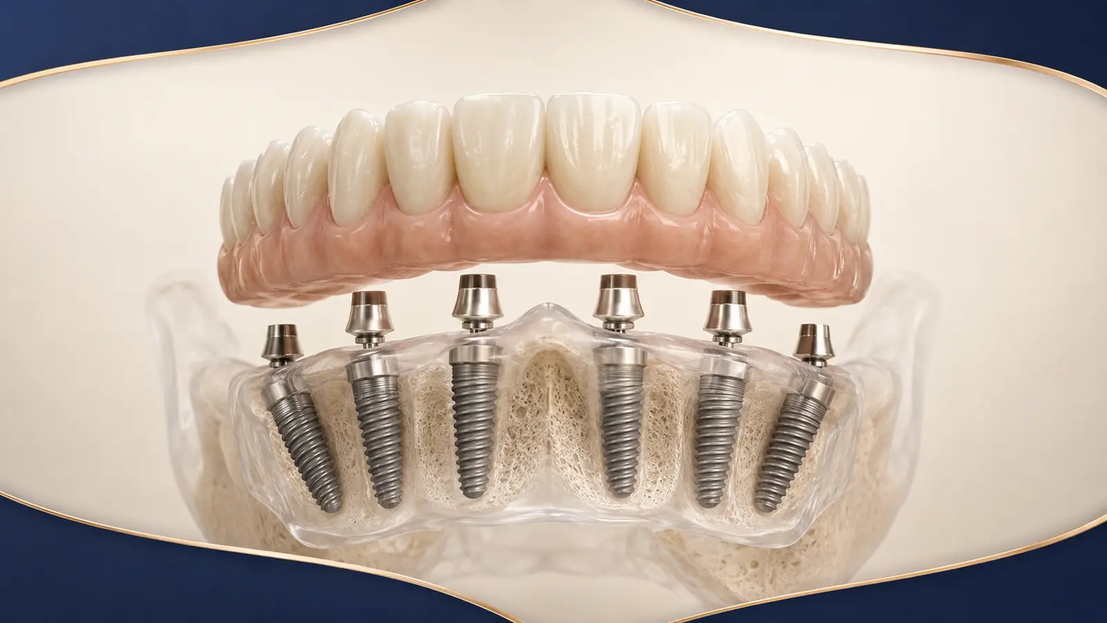 Mâchoire en transparence montrant six implants soutenant une arcade complète